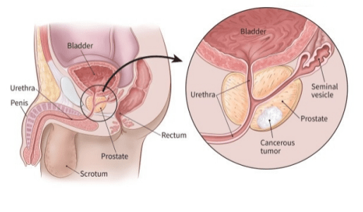 Prostate cancer diagram