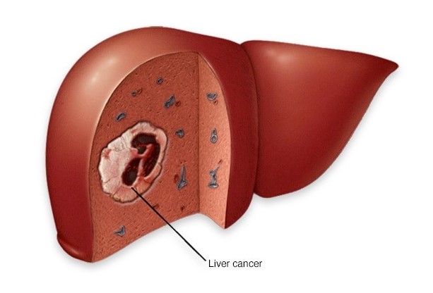 Bdfoie lenvatinib India