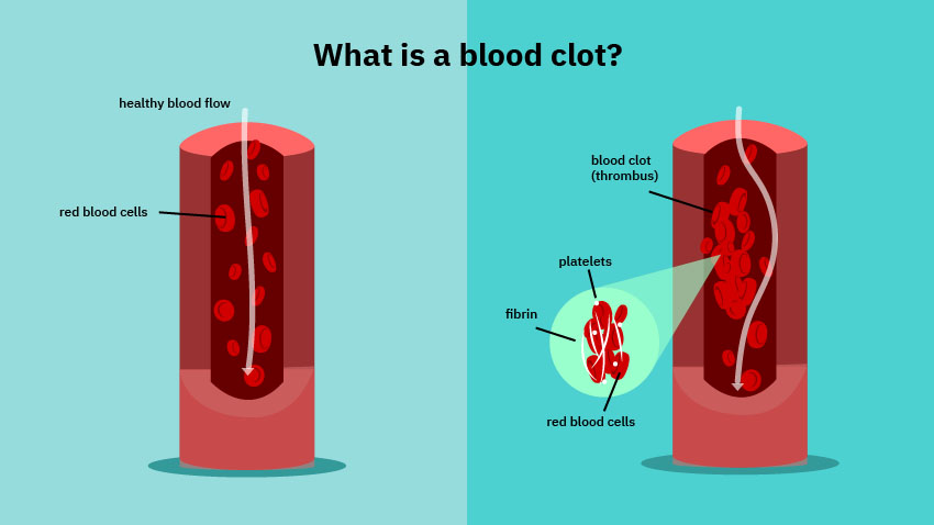 What is blood clot